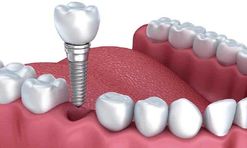 Implant giúp phục hình răng đã mất hoàn toàn
