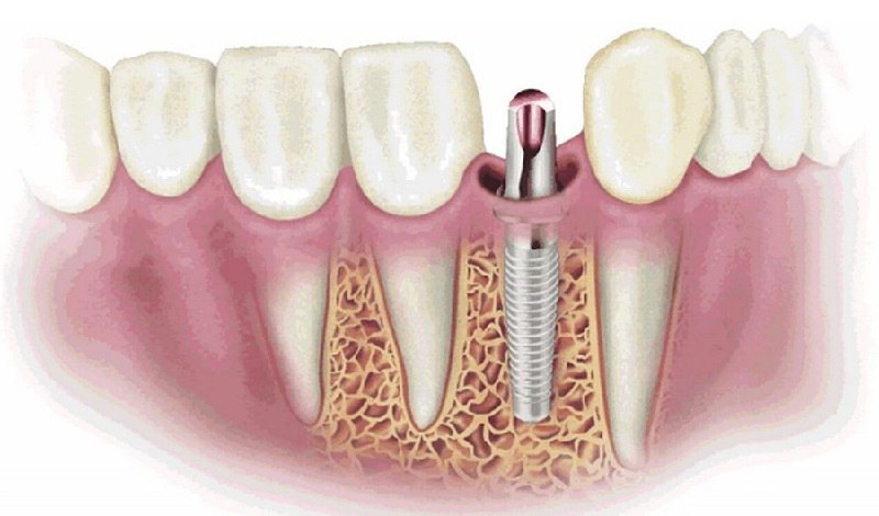 Quá trình phục hình không gây ra ảnh hưởng tới các răng khác