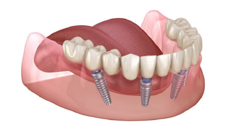 Kỹ thuật cấy ghép Implant áp dụng được nhiều trường hợp cần phục hình răng