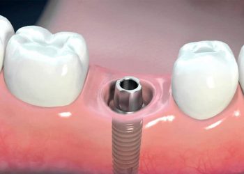 Tiết Lộ 16 Ưu - Nhược Điểm Của Trồng Răng Implant Ít Người Biết 