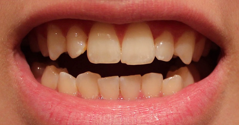Răng bị xỉn màu có thể do tuổi tác
