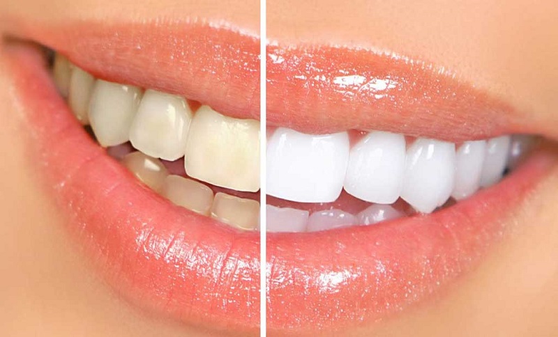 Tẩy trắng răng giúp loại bỏ tính trạng ố vàng