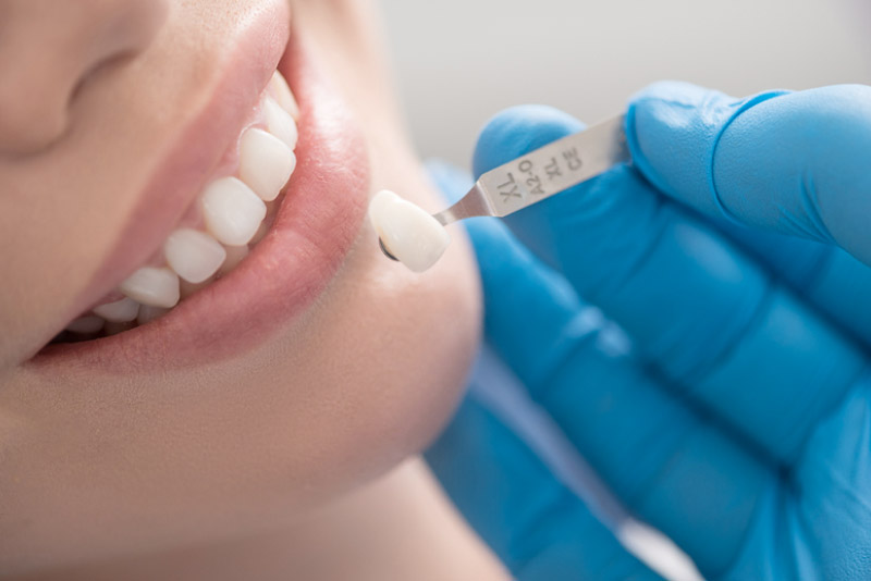 Kỹ thuật phục hình răng sứ chưa chính xác khiến răng bị lung lay