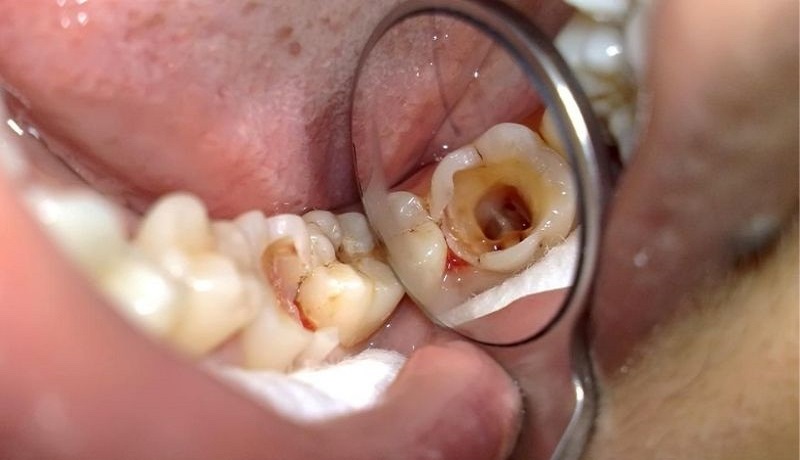 Sâu răng là một trong những nguyên nhân dẫn đến răng chết tủy