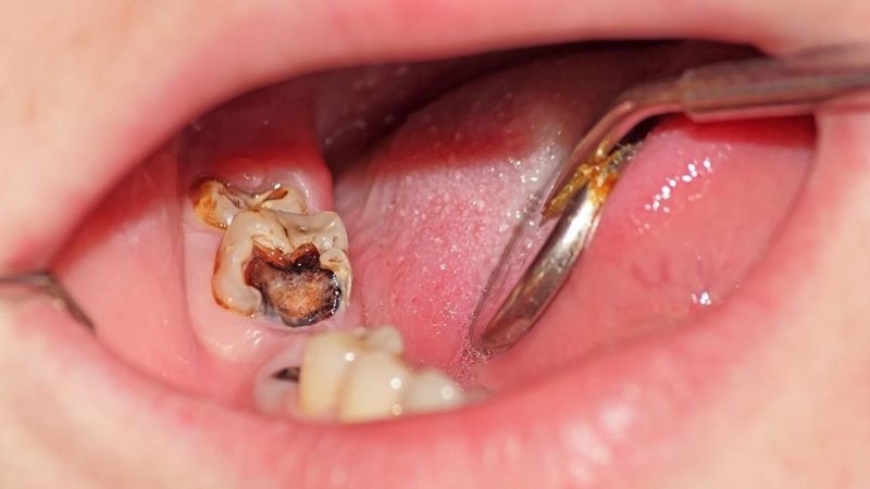Sâu răng hàm là bệnh lý nha khoa rất phổ biến