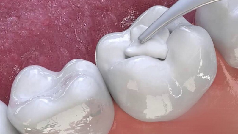 Trám răng sẽ được thực hiện khi răng bị sâu nhẹ