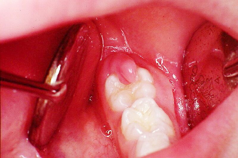 Sưng nướu răng khôn là tình trạng khá phổ biến