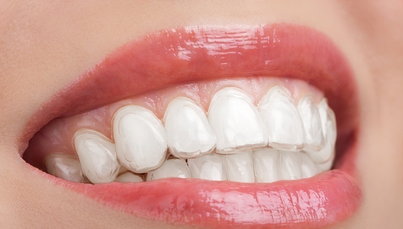 Thời gian đeo máng tẩy phụ thuộc nhiều vào tình trạng răng miệng của bạn