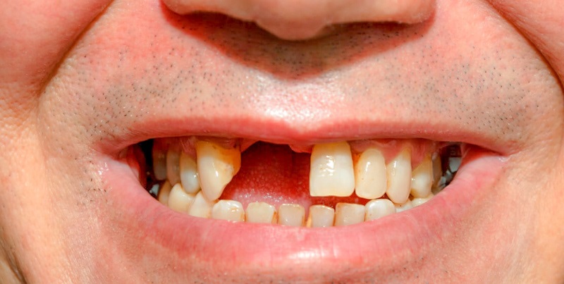 Khi gãy răng cửa, nhiều người thường lựa chọn phương pháp trồng răng cửa bị gãy