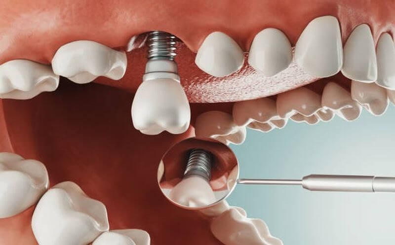 Phương pháp trồng implant ở răng cửa