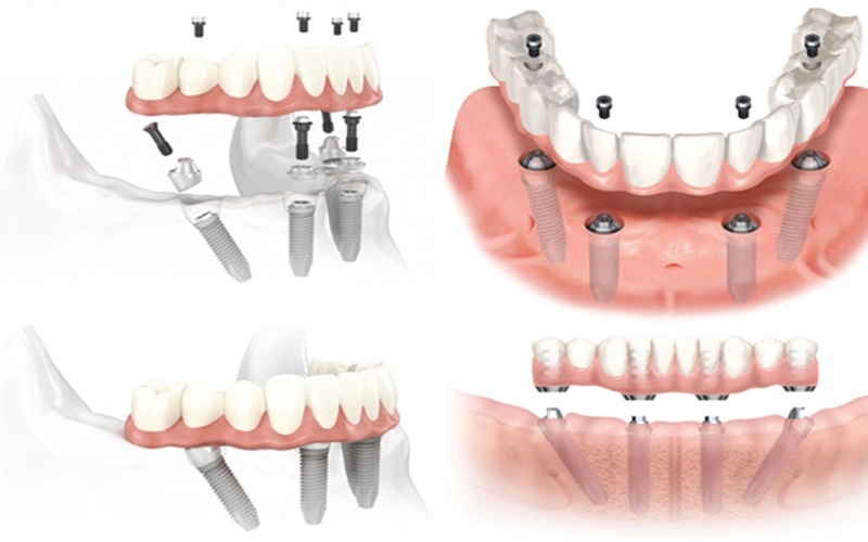 Phương pháp trồng răng tháo lắp giúp khôi phục số lượng và vị trí răng