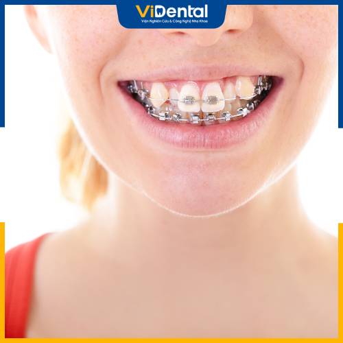 Răng lệch lạc là một trong những trường hợp cần niềng răng sớm