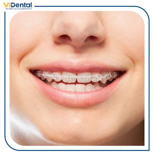 Niềng răng áp dụng cho một số trường hợp như răng hô, móm, mọc lệch