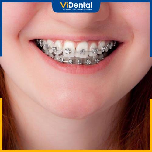 Niềng răng sát hiện nay có 2 loại liềng răng mắc cài truyền thống và niềng răng mắc cài tự đóng