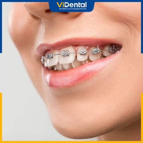 Muốn có một hàm răng đều, đẹp, bạn có thể đến ViDental