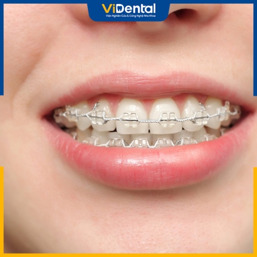 Chỉ cần áp dụng đúng phương pháp, chăm sóc đúng cách chắc chắn sẽ có hàm răng đẹp