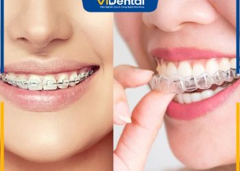[Hỏi đáp] 20 - 23 tuổi có niềng răng được không? Độ tuổi nào chỉnh nha hiệu quả nhất?