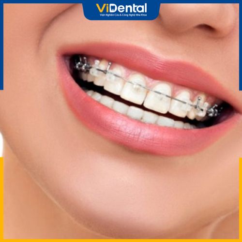Niềng răng 1 hàm sẽ áp dụng cho đối tượng có hàm răng tương đối thẳn