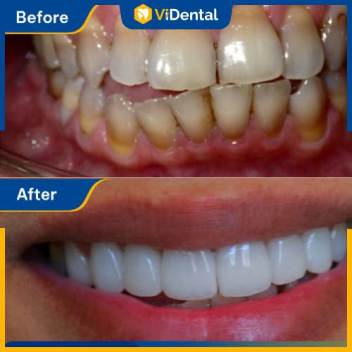 Quy trình phục hình răng sứ đúng chuẩn, mang lại hiệu quả tốt
