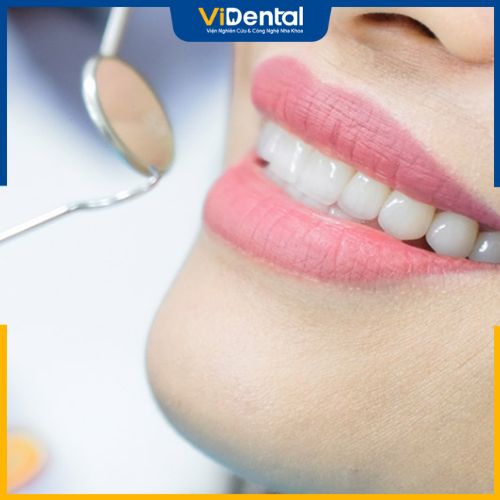 Quy trình bọc răng sứ đã lấy tủy được thực hiện theo 6 bước