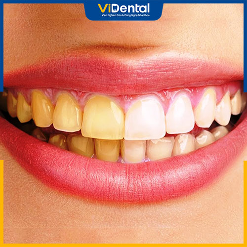 Bọc sứ giúp khắc phục tình trạng răng ố vàng, xỉn màu nặng