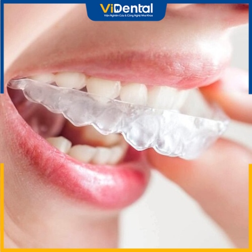 Invisalign là phương pháp niềng răng trong suốt cho tính thẩm mỹ cao