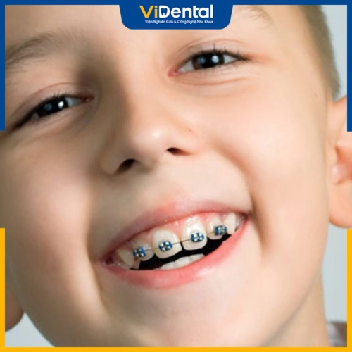 Niềng răng cho trẻ bằng mắc cài kim loại