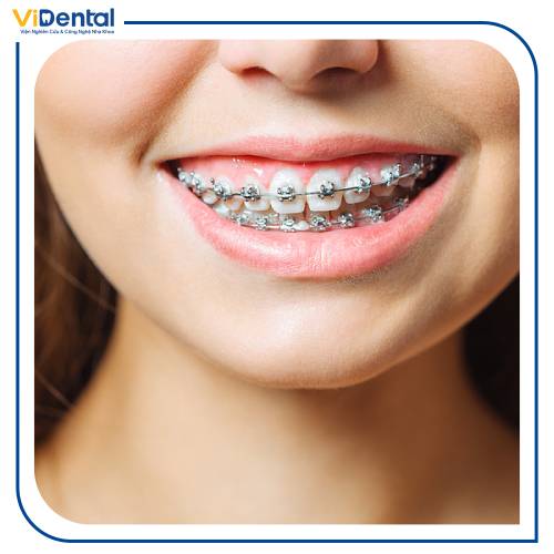 Giá niềng răng khấp khểnh phụ thuộc vào nhiều yếu tố như tình trạng răng, phương pháp niềng, độ tuổi…