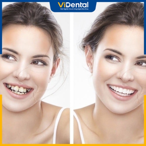 Niềng răng mang tới hàm răng đẹp cùng nụ cười rạng rỡ