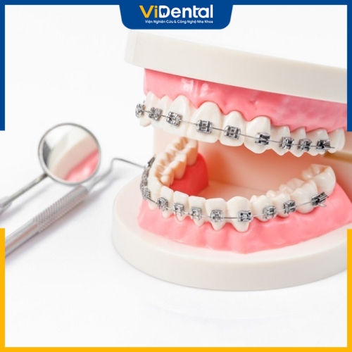 Thời gian niềng răng phụ thuộc vào nhiều yếu tố khác nhau