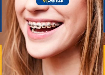 Niềng răng mắc cài kim loại bao lâu để có hiệu quả tốt nhất?