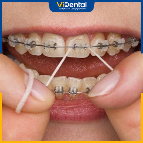 Chăm sóc răng miệng trong quá trình niềng