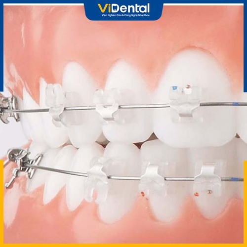 Niềng răng mắc cài sứ có thiết kế tương đồng màu răng, mang đến hiệu quả thẩm mỹ cao