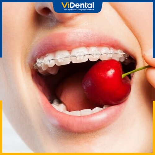Chú ý cách ăn và chăm sóc răng sau khi niềng
