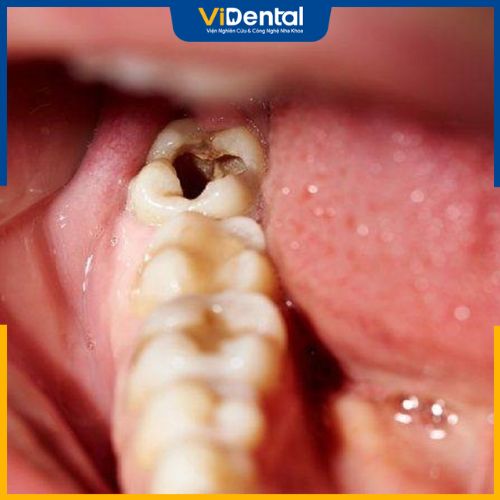 Khi răng bị sâu, viêm tủy có thể thực hiện bọc sứ