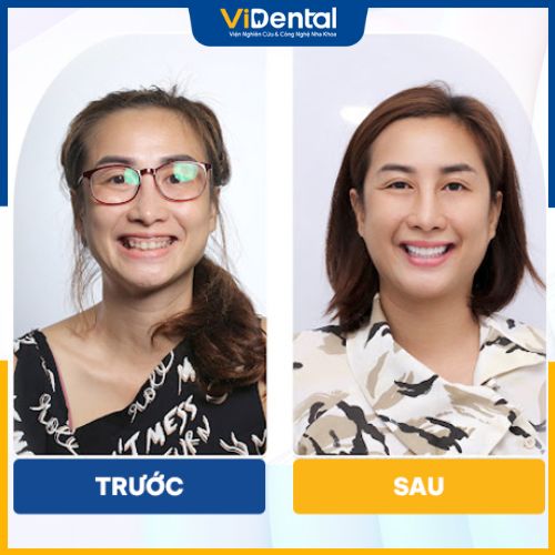 Hình ảnh trước và sau bọc răng sứ của khách hàng tại ViDental
