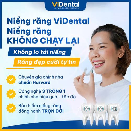 Niềng răng ViDental hiệu quả cao, bảo hành trọn đời