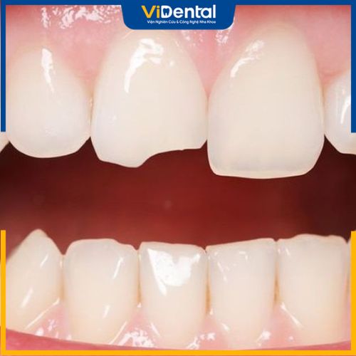 Răng bị mẻ là tình trạng mất một phần nhỏ của cấu trúc răng