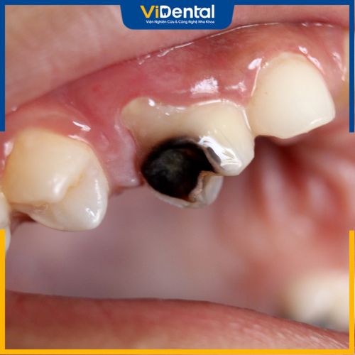 Răng bị mẻ có thể do rất nhiều nguyên nhân