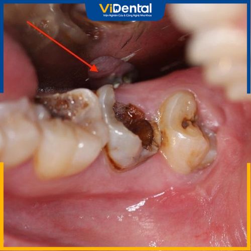 Răng bị vỡ có thể làm tổn thương đến cấu trúc răng
