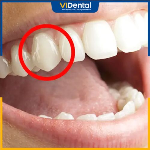 Răng khểnh nằm ở vị trí số 3, có cấu tạo như bình thường