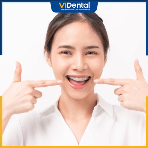 Niềng răng sẽ tạo ra lực điều chỉnh, đưa các răng di chuyển lệch lạc về đúng vị trí