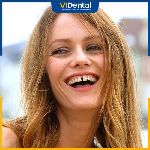 Răng thưa gây ảnh hưởng không tốt đến sức khỏe răng miệng