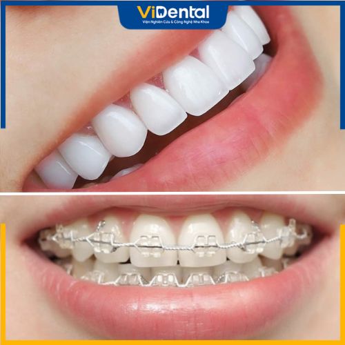 Răng thưa nên chọn niềng răng hay bọc sứ tùy tình trạng cụ thể
