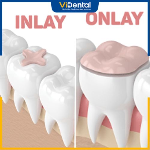 Inlay/Onlay là phương pháp sử dụng miếng trám đúc sẵn để lấp đầy vị trí răng bị tổn thương