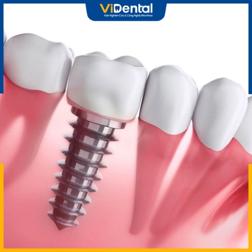 Implant Hiossen mang lại hiệu quả tối đa cho các trường hợp mất và hỏng răng 