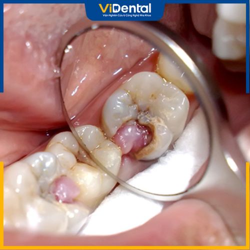 Bệnh sâu răng nếu không được xử lý triệt để có thể dẫn đến viêm tủy
