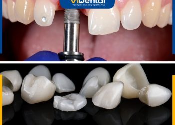 Review Trồng Răng Bằng Cầu Răng Sứ Và Implant Loại Nào Tốt?