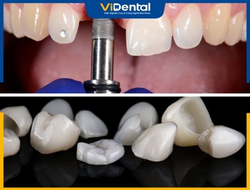 Review Trồng Răng Bằng Cầu Răng Sứ Và Implant Loại Nào Tốt?