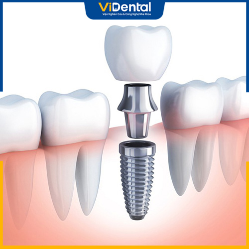 Trồng răng Implant là phương pháp phổ biến nhất hiện nay